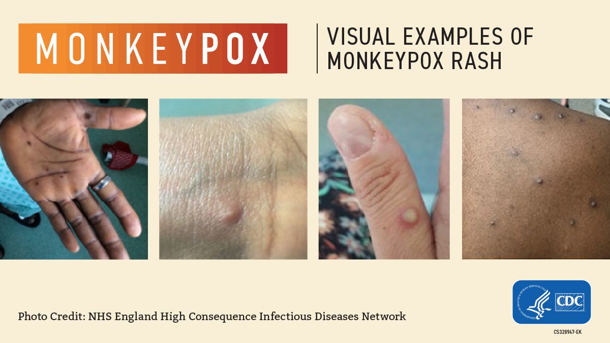 Monkeypox Information and Resources Scott County, Iowa